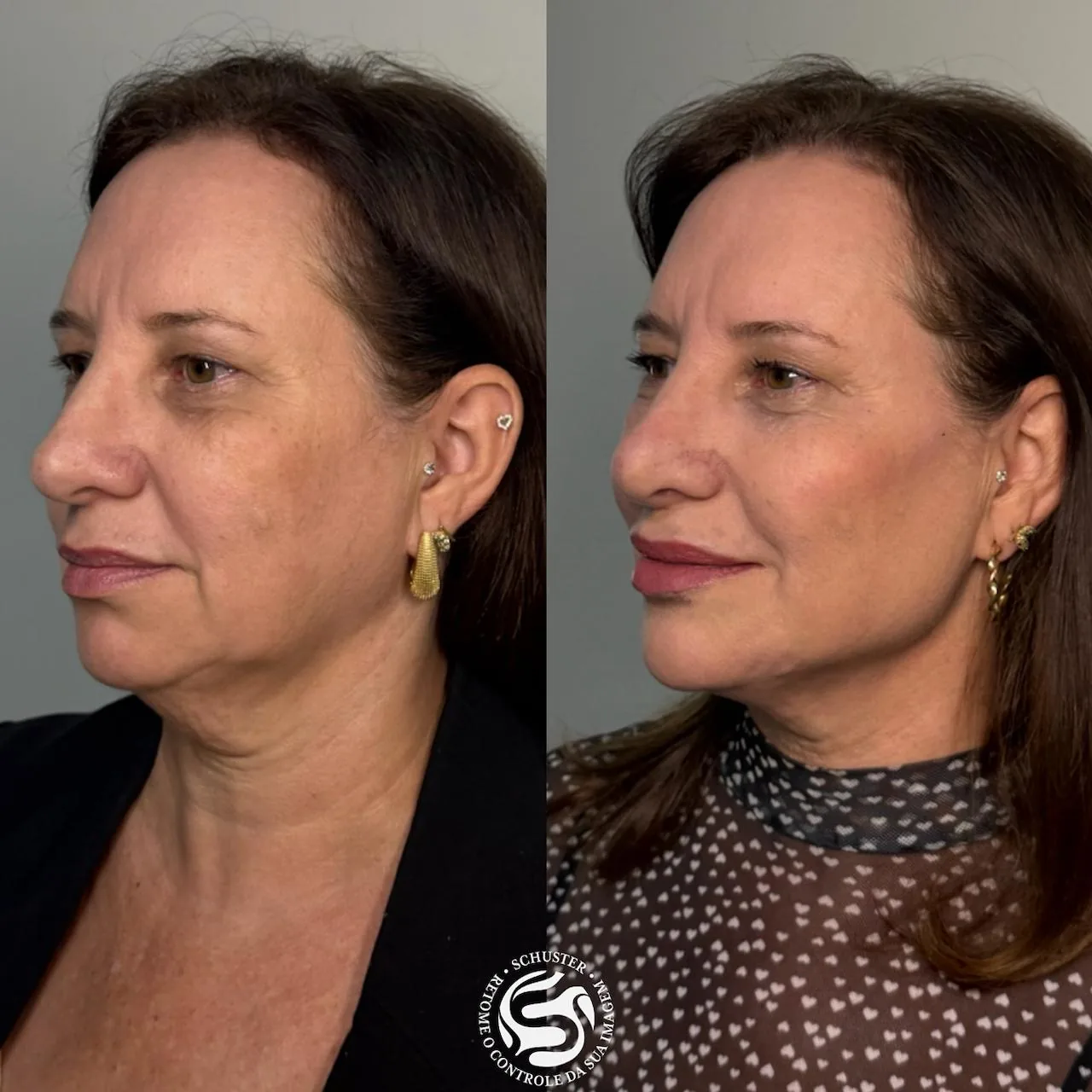 Antes e depois de uma paciente da Schuster Clinic, resultado 01