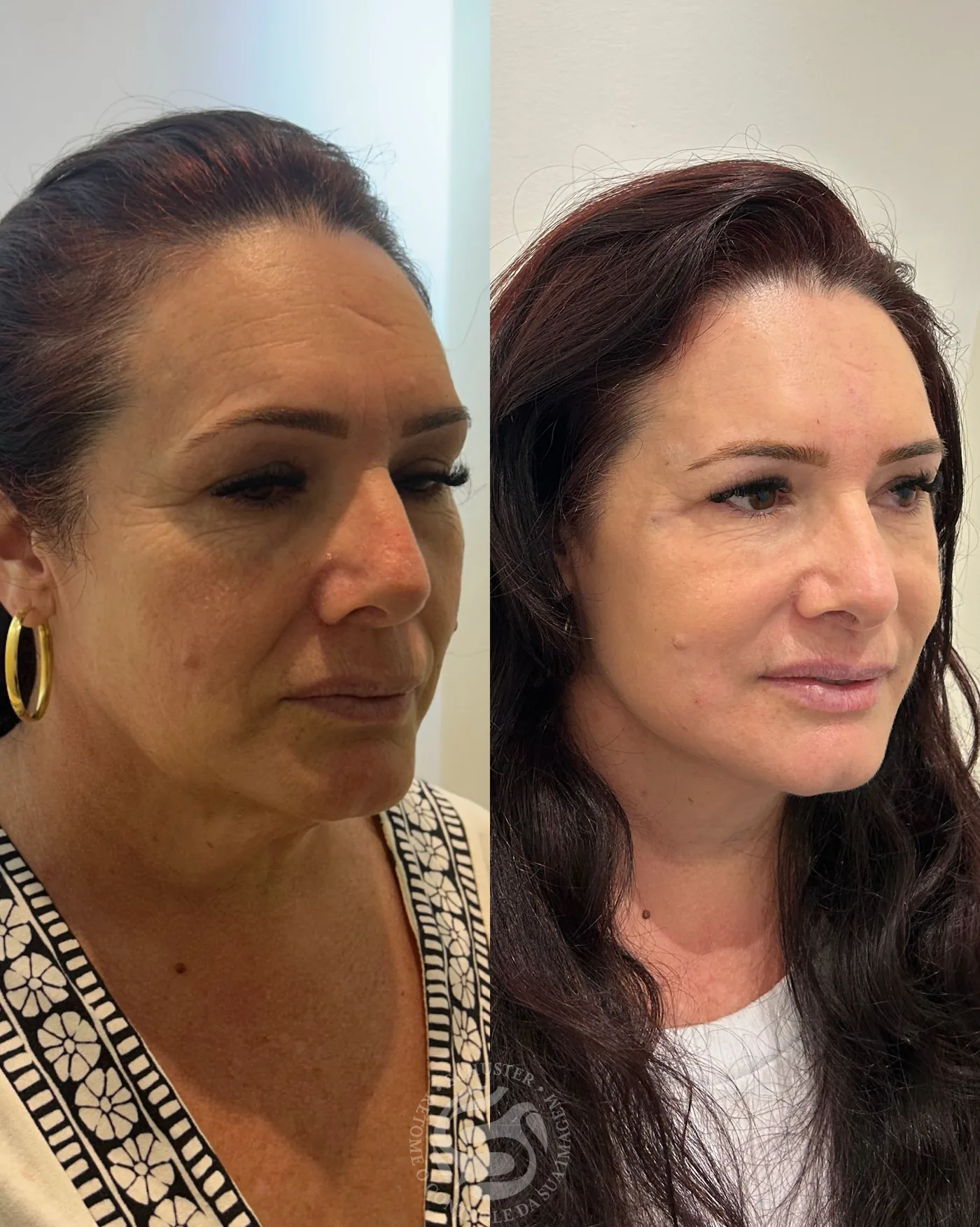 Antes e depois de uma paciente da Schuster Clinic, resultado 02