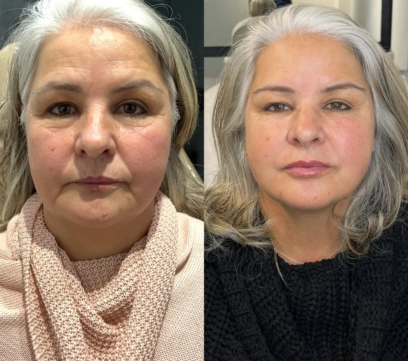 Antes e depois de uma paciente da Schuster Clinic, resultado 03