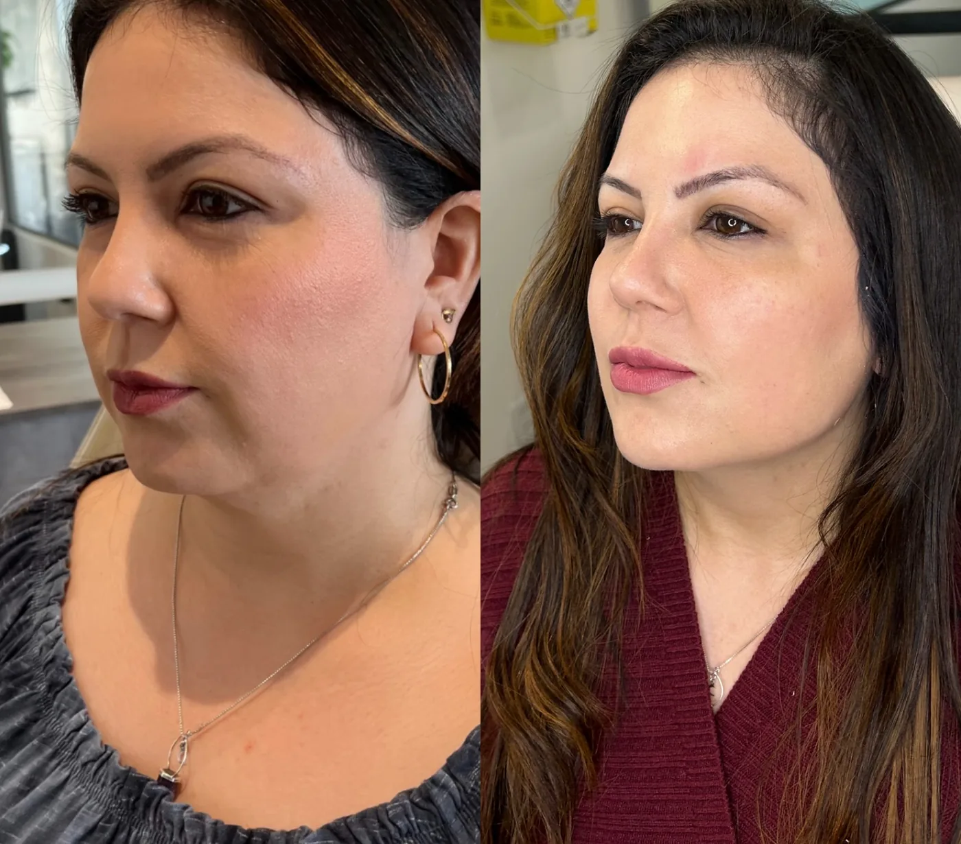 Antes e depois de uma paciente da Schuster Clinic, resultado 06