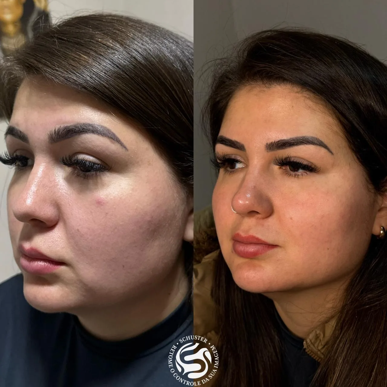 Antes e depois de uma paciente da Schuster Clinic, resultado 07